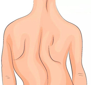 特發(fā)性脊柱側(cè)凸