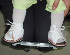 兒童足內(nèi)八字，外八字矯正