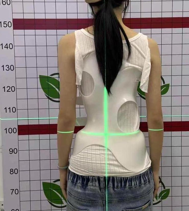 脊柱側(cè)彎穿戴