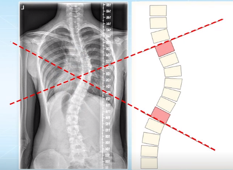 脊柱側(cè)彎的角度測量