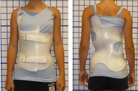 脊柱側彎的呼吸加支具