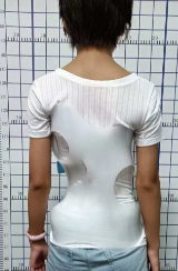 脊柱側(cè)彎的治療