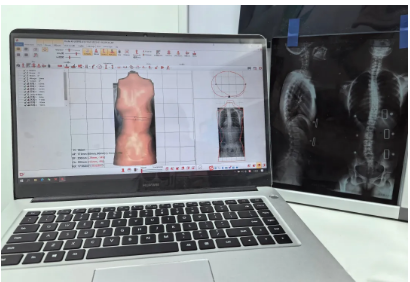 科學(xué)面對(duì)脊柱側(cè)彎