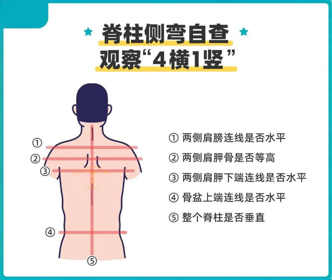 脊柱側彎與家庭自查
